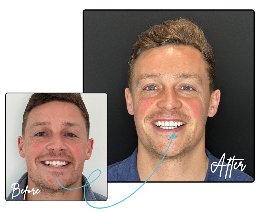 Invisalign® - Just Smile Dentistry Ashfield