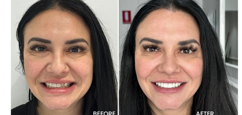 Porcelain Veneers Lifespan vs Composite Veneers Lifespan