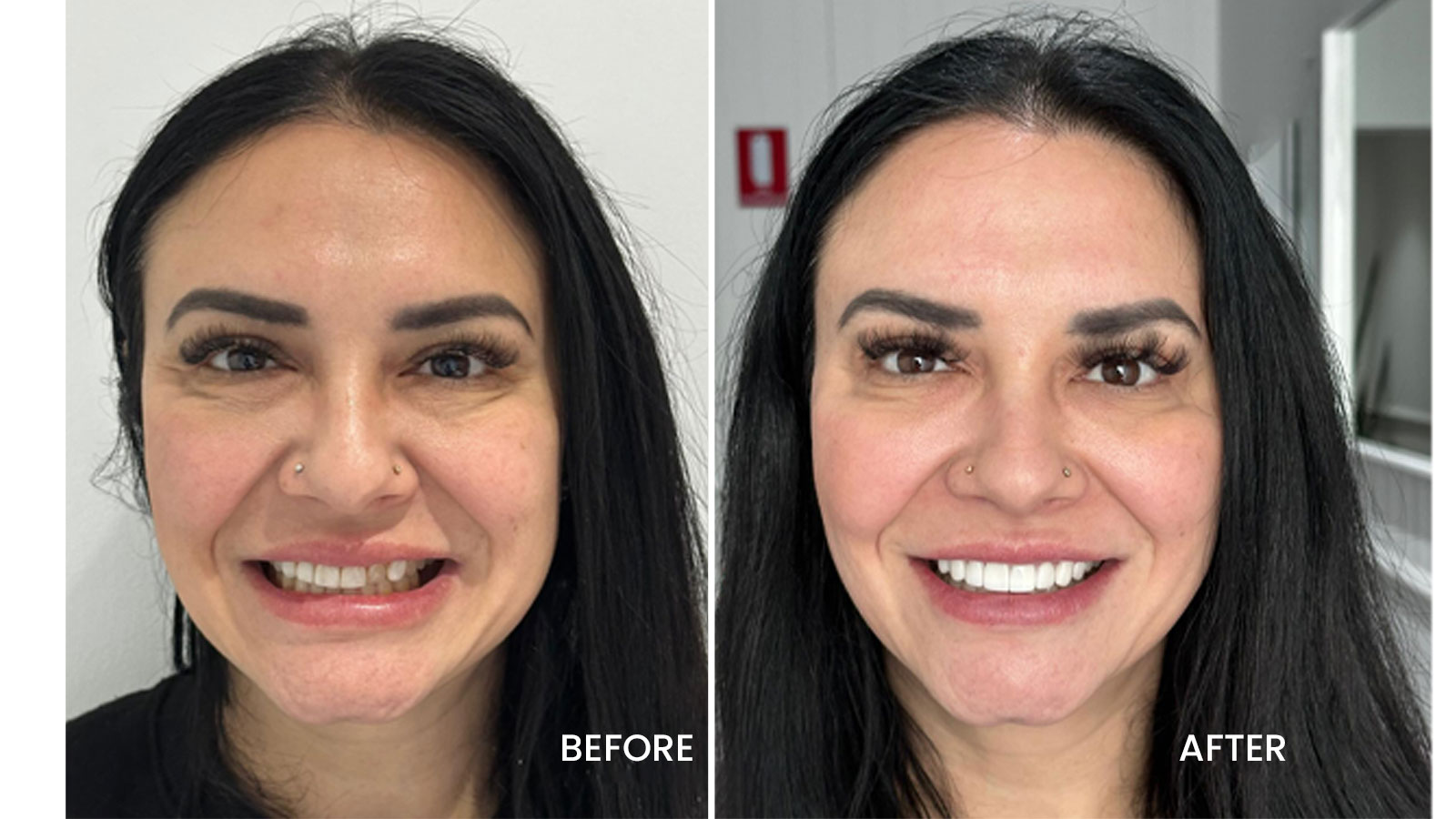 Porcelain Veneers Lifespan vs Composite Veneers Lifespan