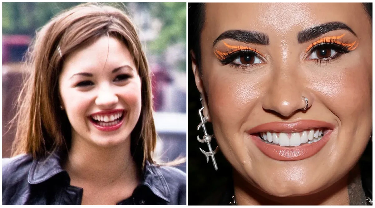 Demi Lovato Veneers Transformation of Teeth