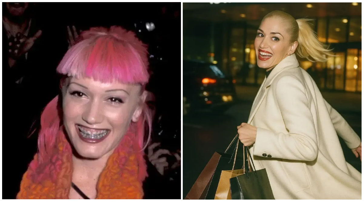 Gwen Stefani Veneers Transformation of Teeth