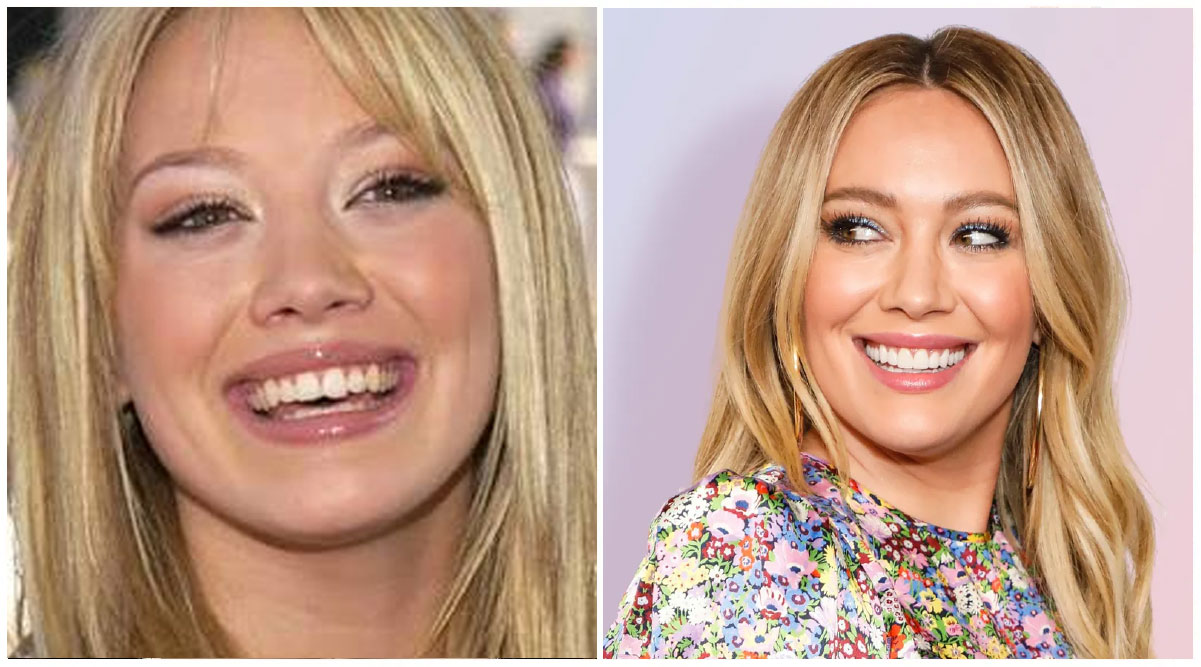 Hilary Duff Veneers Transformation of Teeth