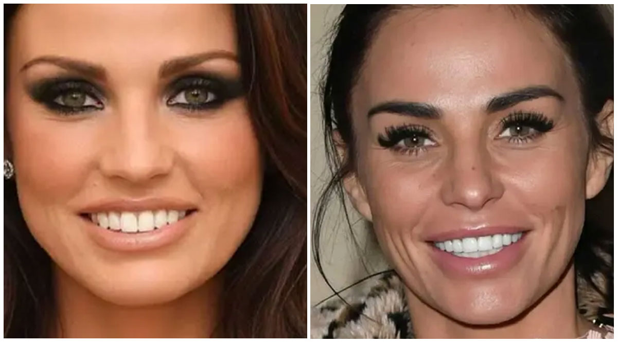 Katie Price Veneers Transformation of Teeth