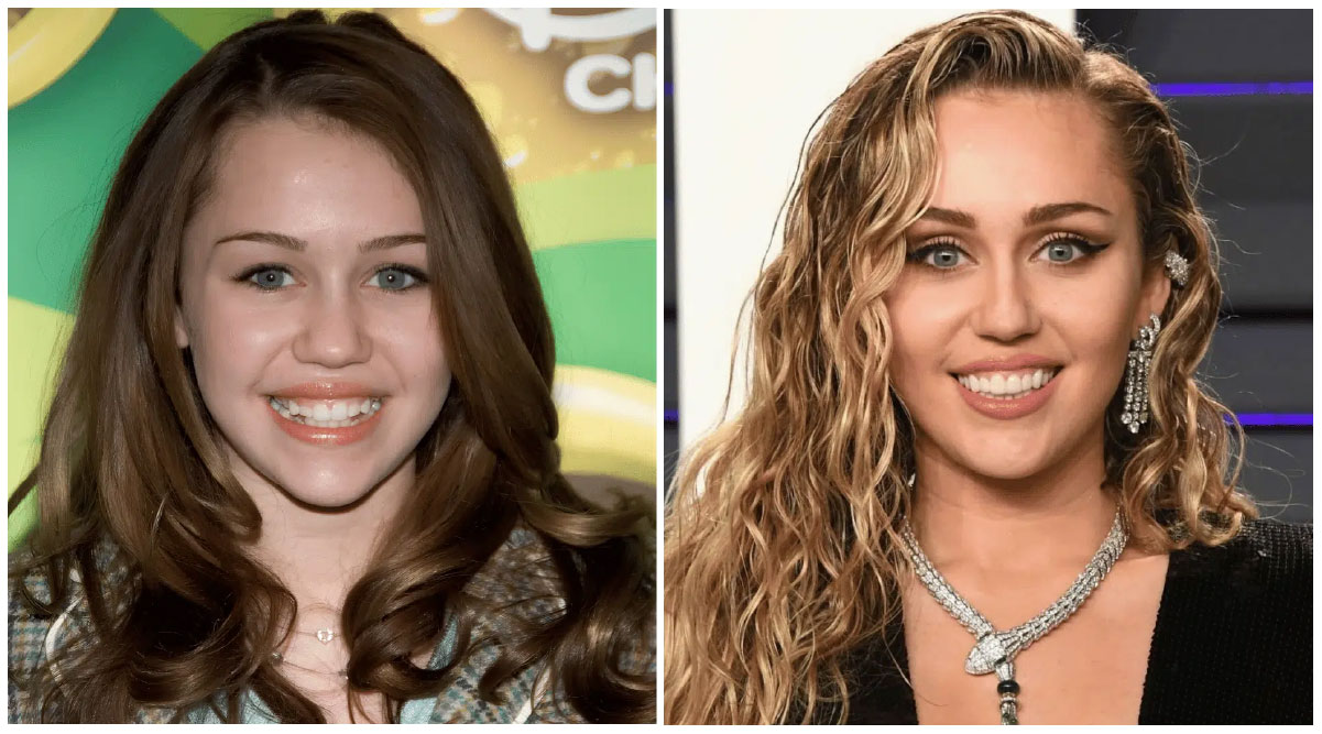Miley Cyrus Veneers Transformation of Teeth