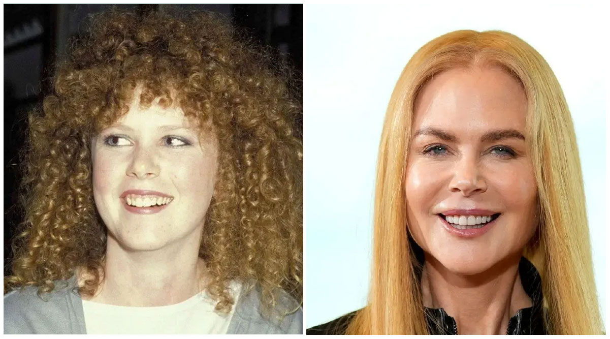 Nicole Kidman Veneers Transformation of Teeth