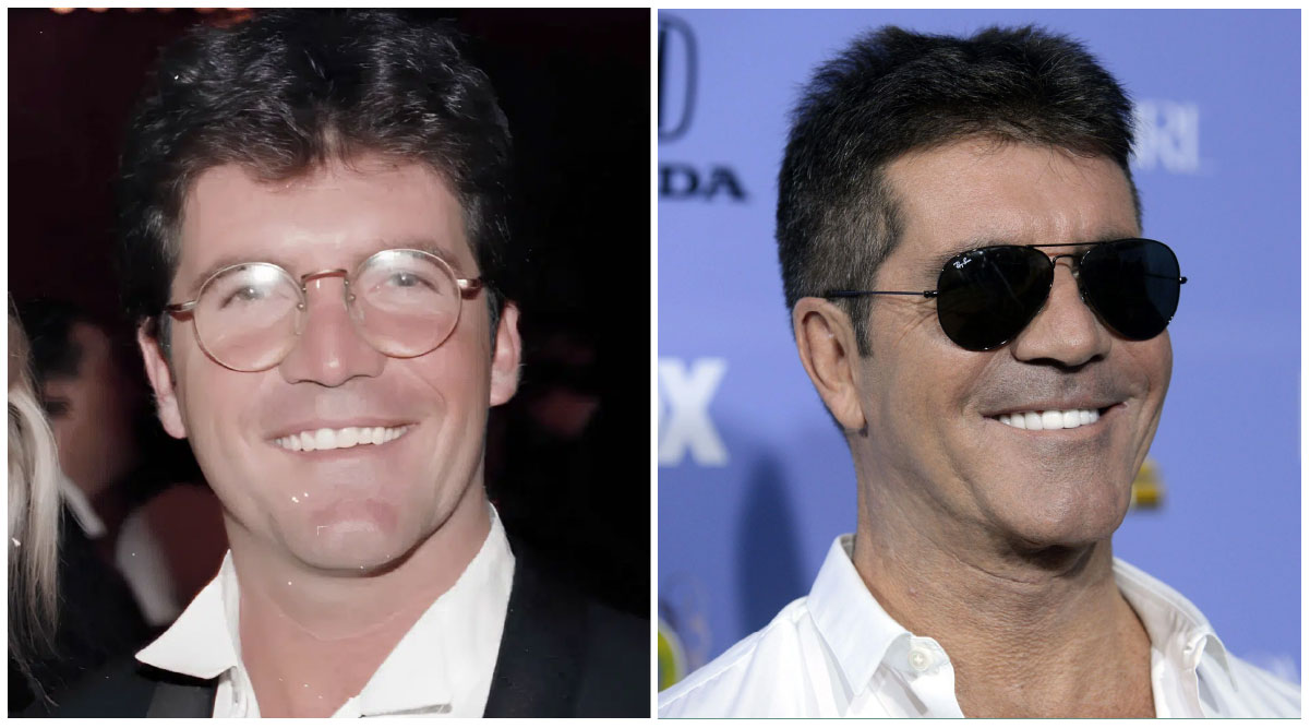 Simon Cowell Veneers Transformation of Teeth