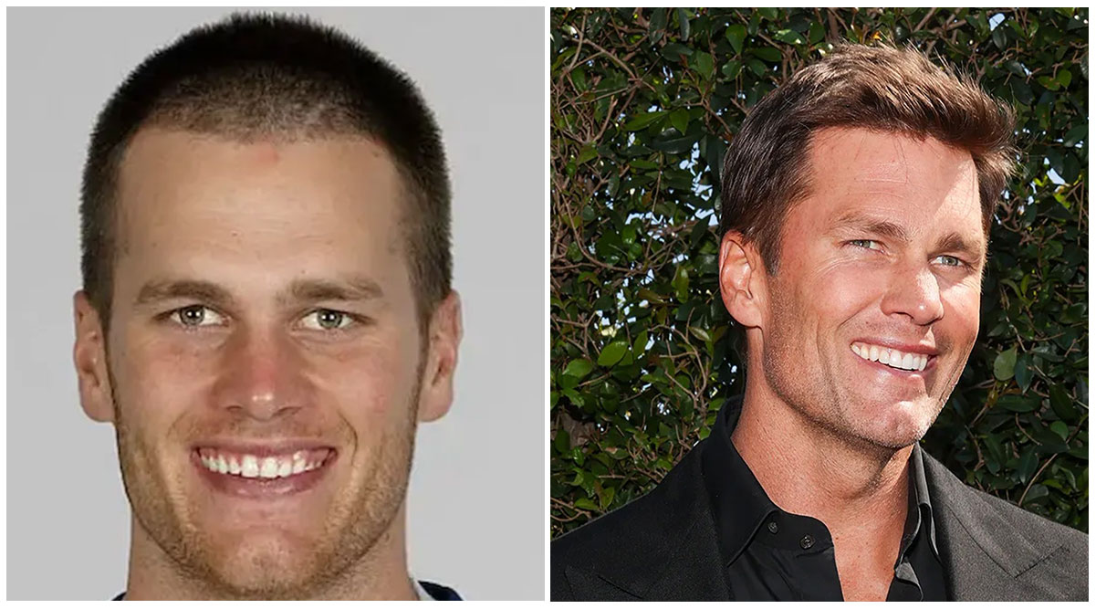 Tom Brady Veneers Transformation of Teeth