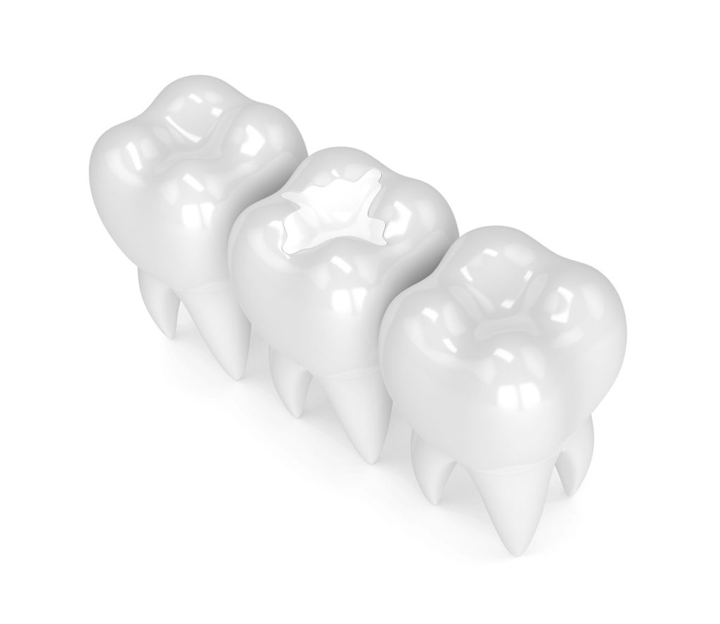 Tooth-Coloured Fillings Sydney