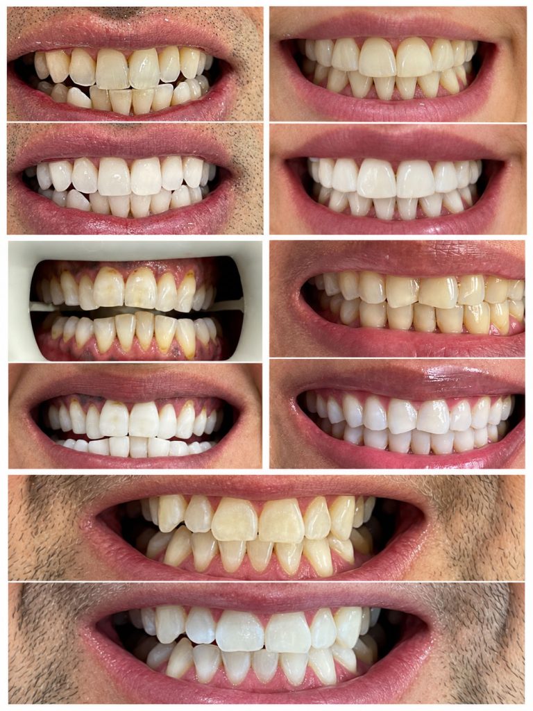 Teeth Whitening Sydney